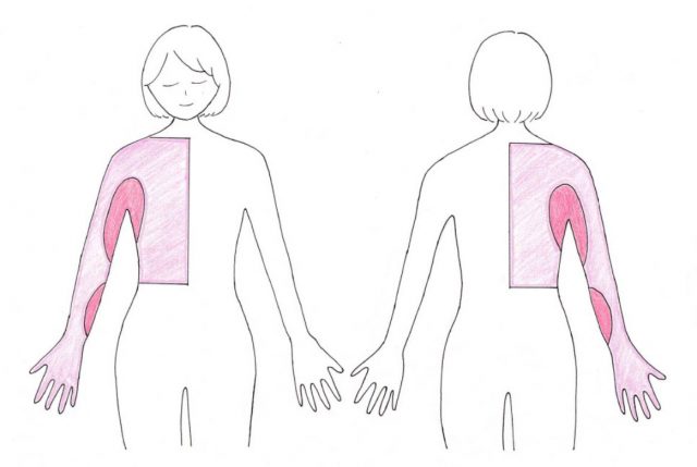 浮腫みがでやすい場所 上肢